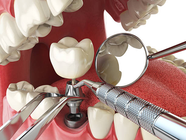 Best Broken or Chipped Tooth Repair in West Melbourne, FL